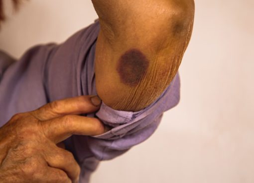 ¿Por qué salen moretones sin golpes en adultos mayores?: causas y señales de alerta