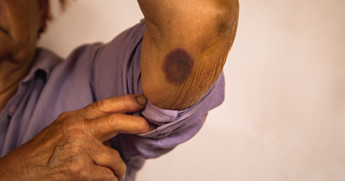 ¿Por qué salen moretones sin golpes en adultos mayores?: causas y señales de alerta